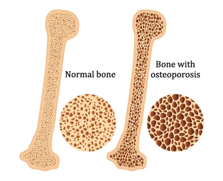 Recomendaciones para osteoporosis | Pieno Salud