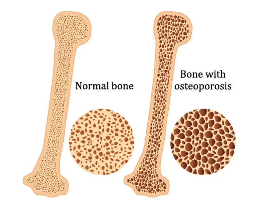 Recomendaciones para osteoporosis | Pieno Salud